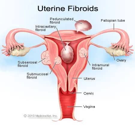 Uterus with Fibroid